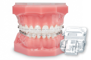 Damon Teeth and Bracket